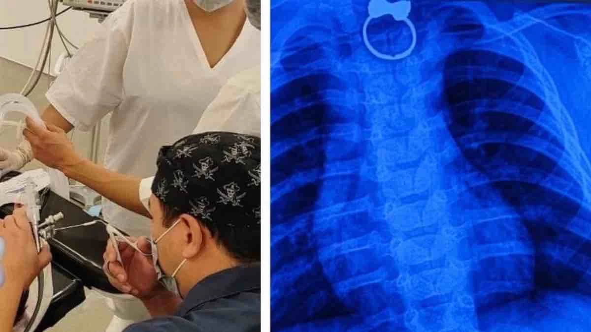 Таразда жеті айлық бала сақина жұтып қойған